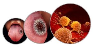 Oral cancer signs